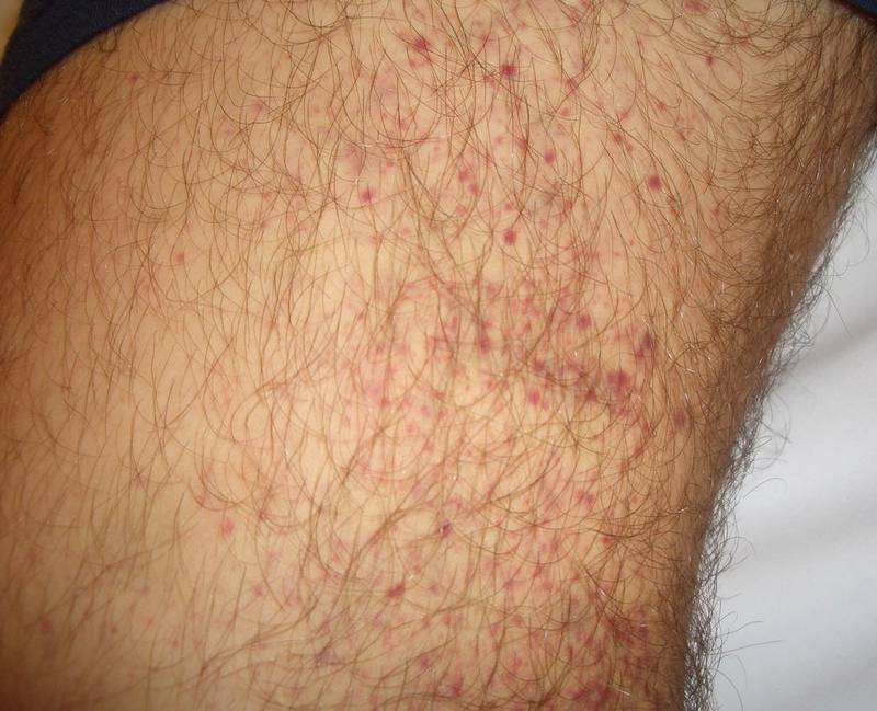 ÐšÐ°Ñ€Ñ‚Ð¸Ð½ÐºÐ¸ Ð¿Ð¾ Ð·Ð°Ð¿Ñ€Ð¾ÑÑƒ red pin prick rash on legs