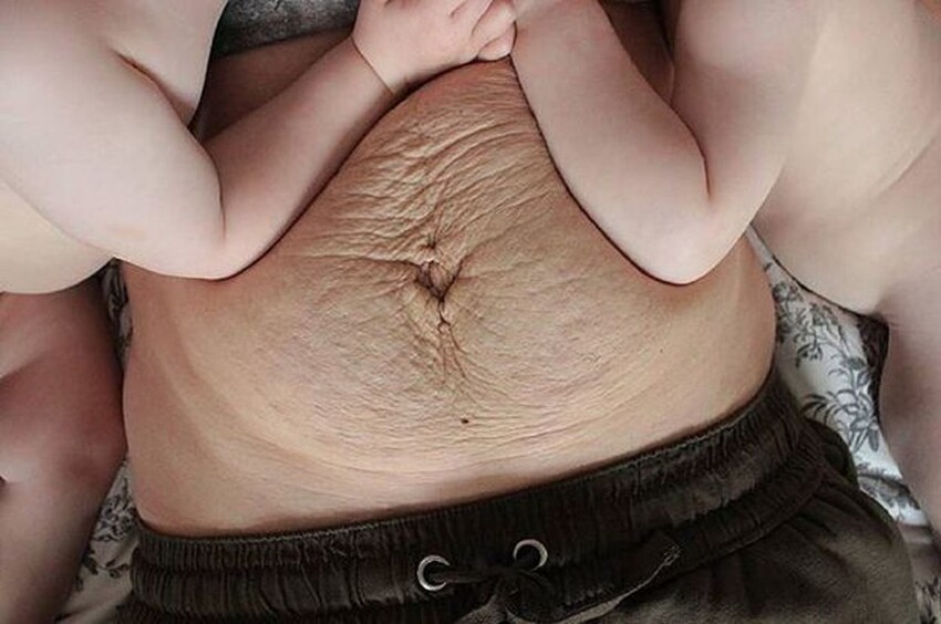 15 шокирующих фото после беременности: ужас, как плата за ребенка красота,тело,фотография