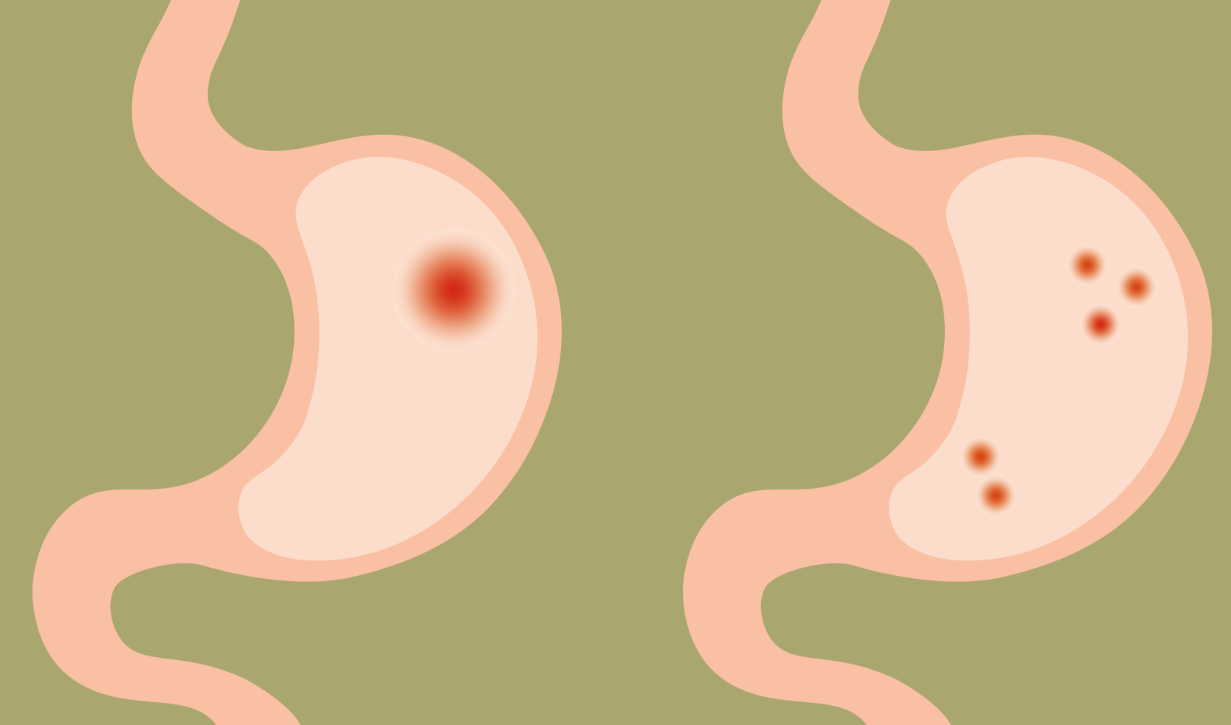 Вылечил гастрит и уже много лет не знаю боли и мучений