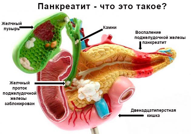 Что полезно знать про острый панкреатит здоровье, панкреатит, поджелудочная железа