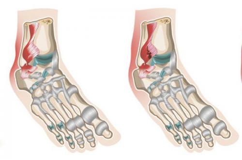 Мазь от растяжения связок на ноге. Лечение повреждения связок голеностопного сустава 1–2 степени