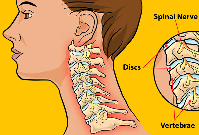 8 эффективных домашних средств для облегчения боли в шее