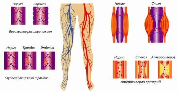 Тромбоз: как уберечься? Факторы риска и меры профилактики вены,кровь,тромб