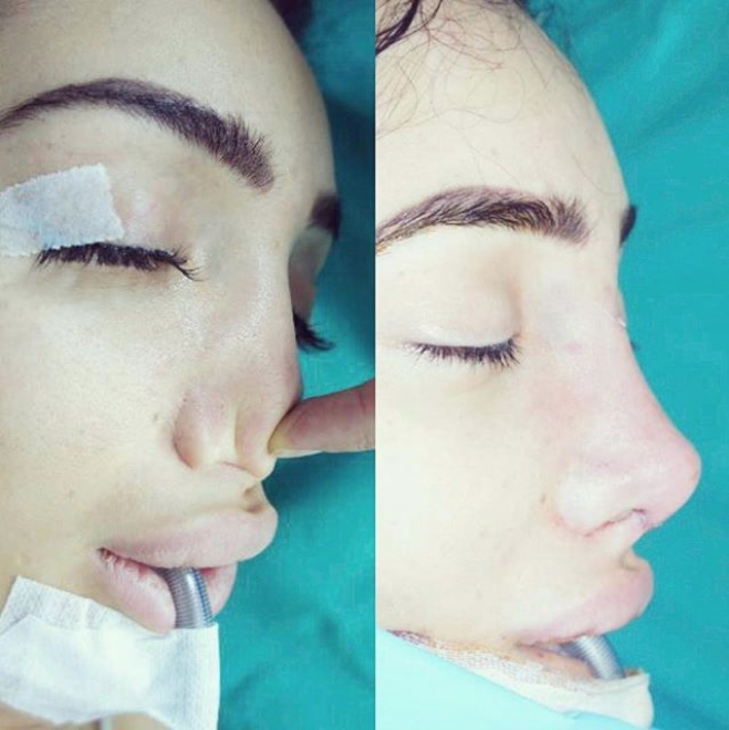 Операции на нос после операции фото