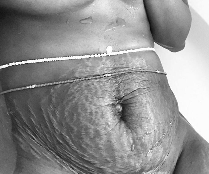 15 шокирующих фото после беременности: ужас, как плата за ребенка красота,тело,фотография
