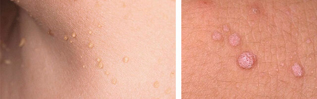 Папилломы как признак наличия паразитов Папилломы как признак наличия паразитов