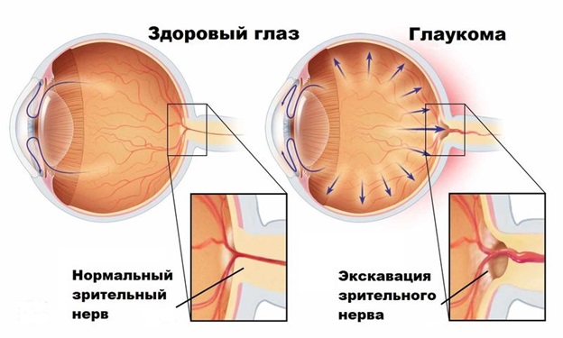 Атрофия зрительного нерва при глаукоме