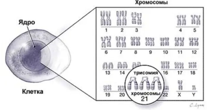 Почему люди с синдромом Дауна так похожи друг на друга? людей, синдромом, Дауна, человека, заболевания, можно, всего, будут, далеко, часто, заболевание, является, развитие, довольно, когда, особенности, признаки, проявляться, окружающих, хромосом