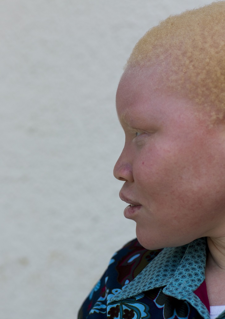 Трагические истории танзанийских альбиносов