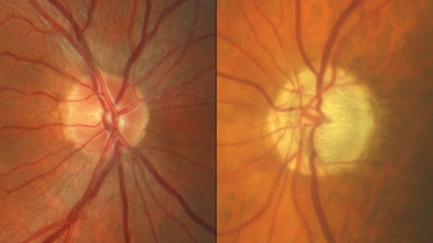 Бледные диски зрительных нервов при глаукоме