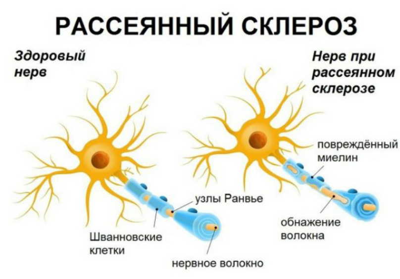 Рассеянный склероз: 14 тревожных симптомов заболевания. Как избежать этой тяжелой болезни?