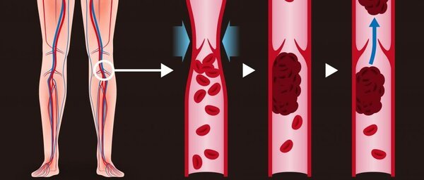 Тромбоз: как уберечься? Факторы риска и меры профилактики вены,кровь,тромб