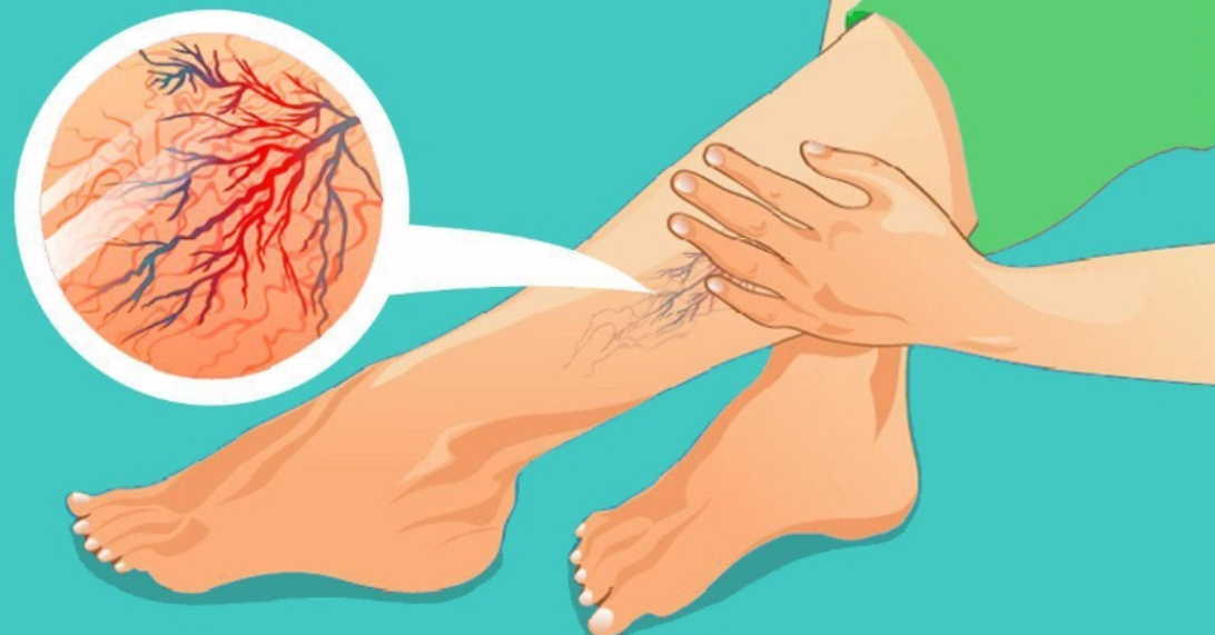 Варикозное расширение вен: 10 рецептов лечения без таблеток и операции