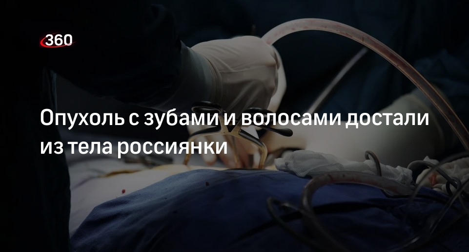 Крупную опухоль с зубами и волосами вырезали из тела пациентки в Чувашии