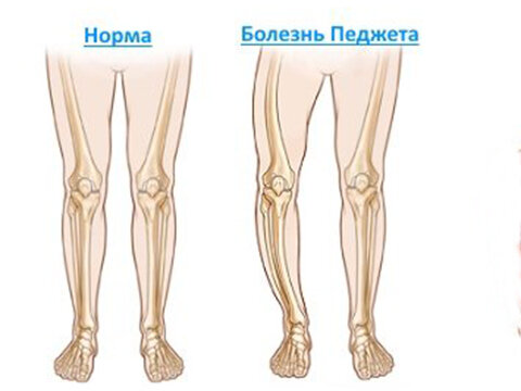 7 симптомов остеопороза, которые мы игнорируем могут, также, остеопороза, перелом, может, витамина, чтобы, костной, развития, можете, которые, является, кости, кальция, дефицит, старше, заболевание, костей, включают, часто