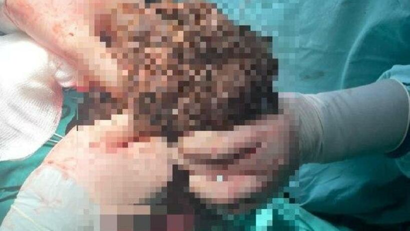 Щелковские врачи спасли девушку, удалив из ее желудка 3‑килограммовый комок волос