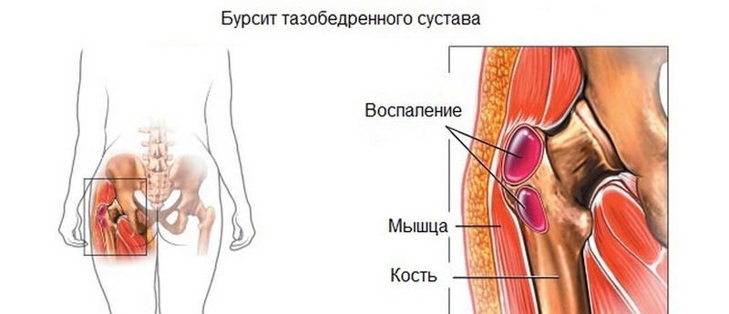 О чем говорит боль в суставах воспаление, сустава, заболевания, суставах, синовиальной, крови, может, сустав, обратиться, области, также, ощупывании, локтевого, процесс, заболевание, покраснение, подтверждается, хирургу, болей, припухлость