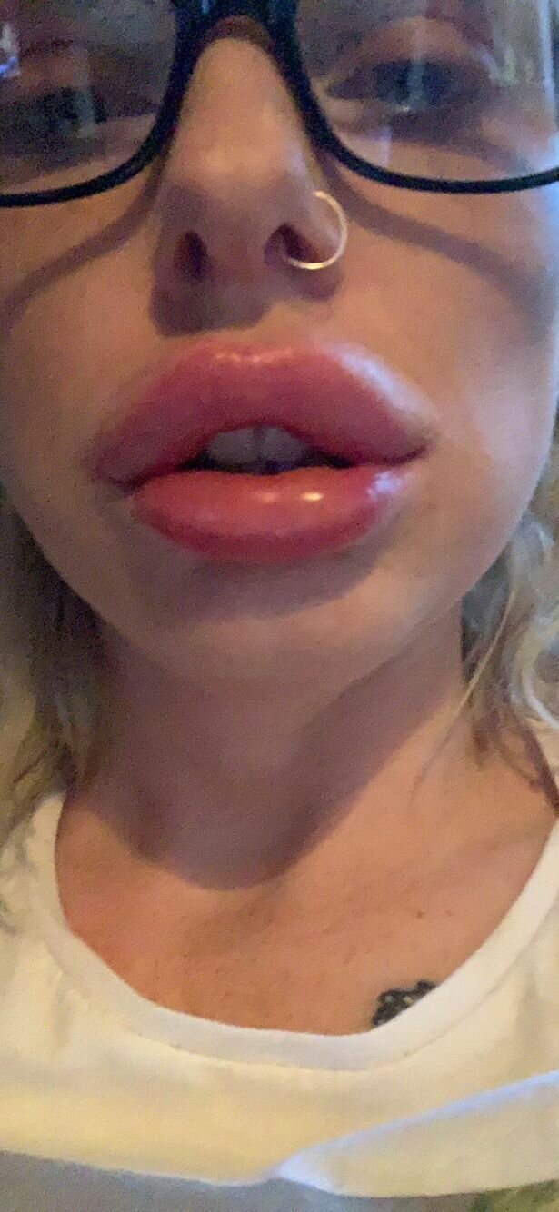 "Горшочек, не вари!": девушка показала эффект помады "для увеличения губ" аллергическая реакция, аллергия, губы, история из жизни, косметология, помада, увеличение губ