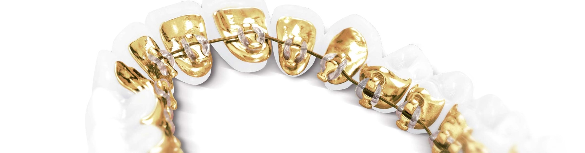 Стоматология шлепковых. Брекеты из золота. Позолоченные брекеты. Золотые брекеты с бриллиантами.