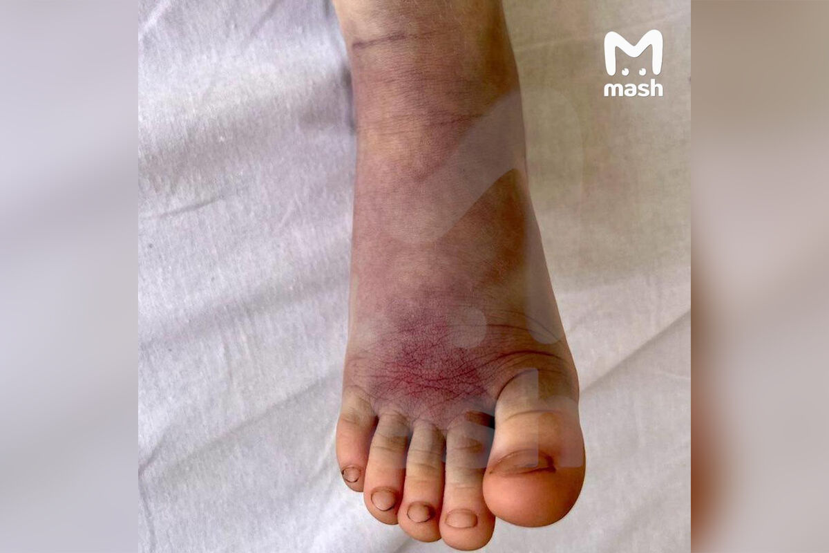 Mash: в Подмосковье четырехлетний мальчик попал в больницу после укуса гадюки
