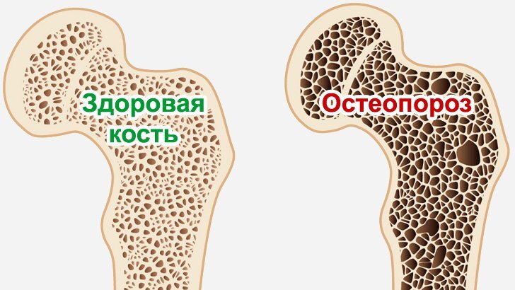 Остеопороз — очень распространенное заболевание, которое может даже быть опасным для жизни, особенно среди групп риска.