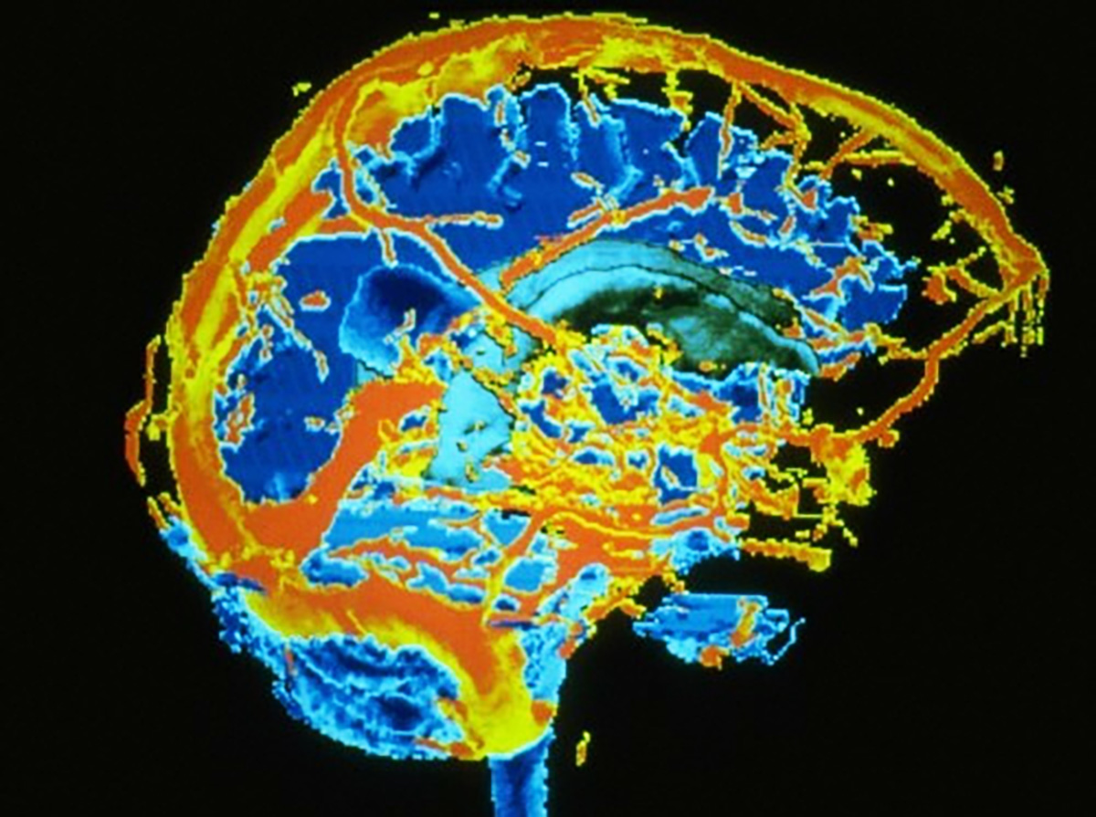 Трехмерная МРТ мозга человека