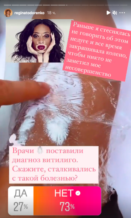 Регина Тодоренко рассказала о своей неизлечимой болезни: "У всех великих людей она была, даже у Майкла Джексона" Регина Тодоренко рассказала о своей неизлечимой болезни: "У всех великих людей она была, даже у Майкла Джексона" Звезды,Новости о звездах