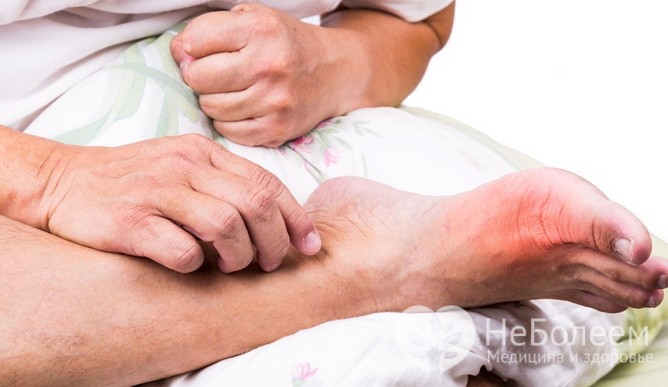  Подагра – одна из причин отечности ног 