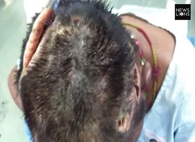 В Индии нашли бездомную с изъеденной червями головой