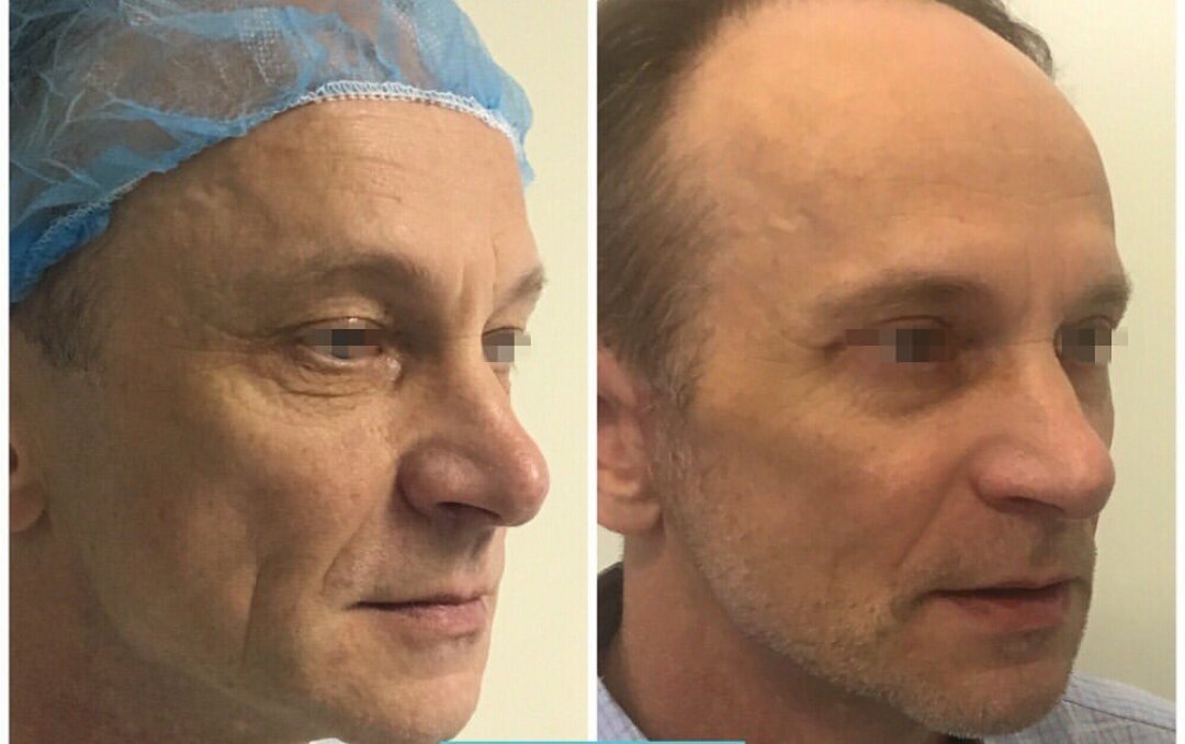 Стас михайлов фото до и после операции пластической операции