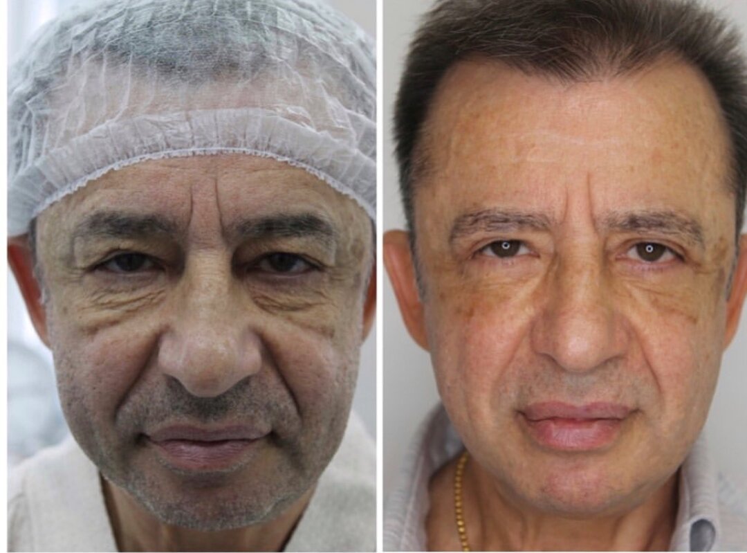 Пластическая операция на лицо мужчин