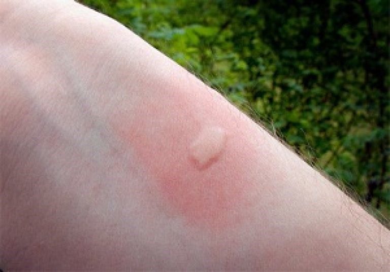 Можно ли заболеть от укуса комара?