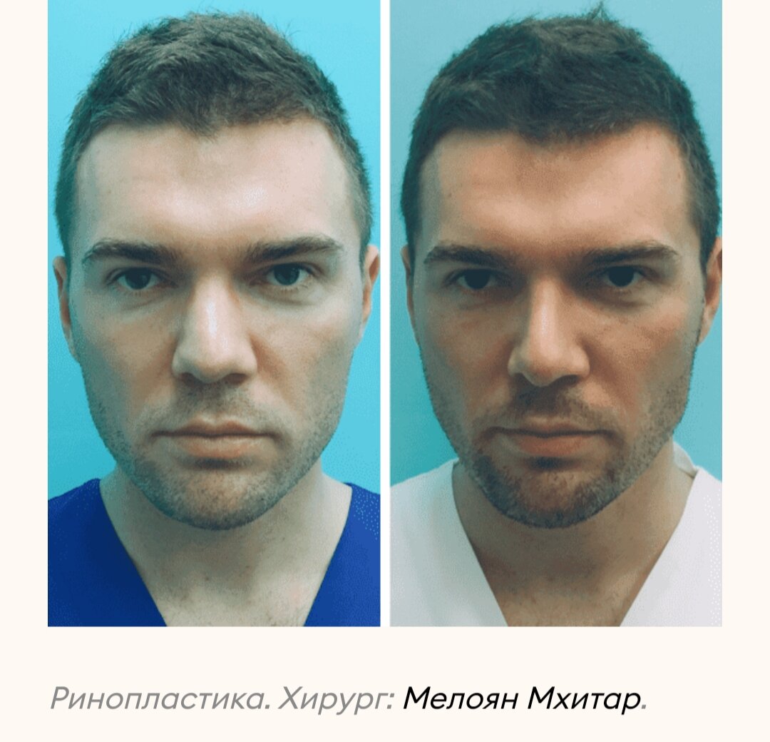 фото мужчин после операции