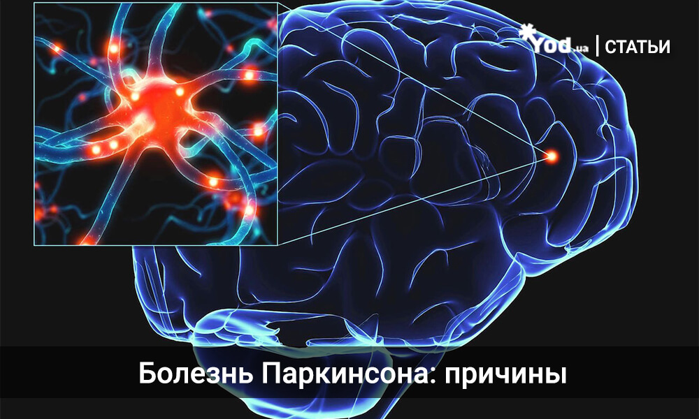 Болезнь Паркинсона болезни, болезнь, Паркинсона, стадия, пациента, паркинсонизм, больного, мозга, постепенно, обычно, заболевания, паркинсонизма, протяжении, часто, пациентов, примерно, всего, смесь, результатом, принято