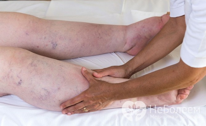  Нарушения оттока лимфы – одна из причин отечности ног 
