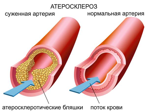 артерии