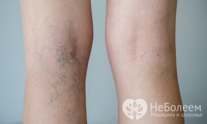  Венозная недостаточность – одна из причин отечности ног 
