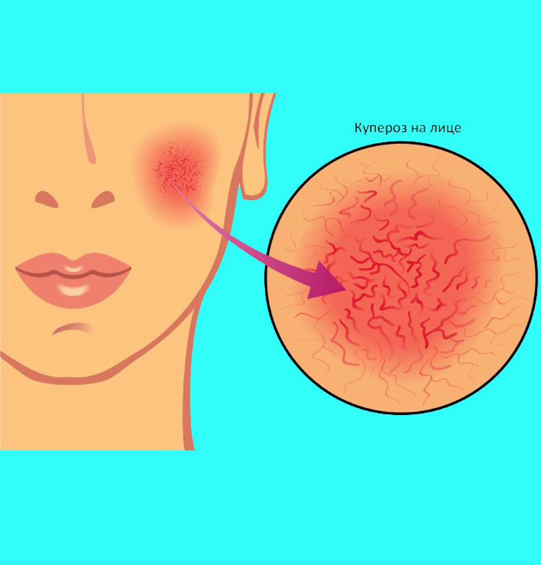 Купероз: Как избавиться от красной сосудистой сетки на лице