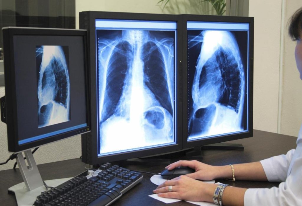 Видно ли туберкулез на снимке рентгена?