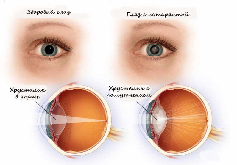 5 растений от катаракты. Эта болезнь поражает 55% людей после 50 лет!