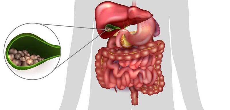 Холецистит: упражнения для усиления желчеотделения здоровье,упражнения
