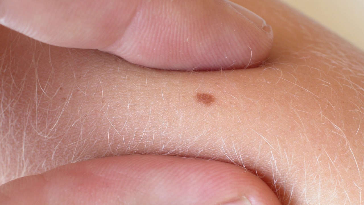 Дерматовенеролог Старицын рассказал о необходимых действиях при повреждении родинки