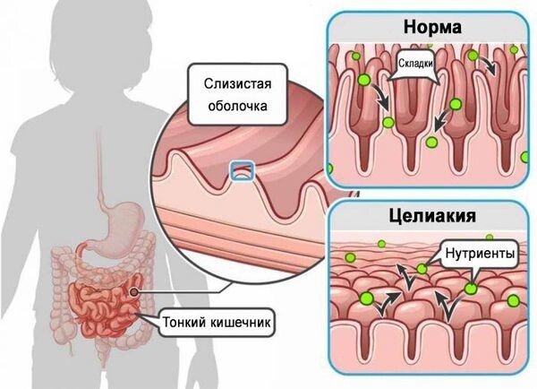 13 неочевидных признаков того, что у вас или ребёнка непереносимость глютена, которые важно знать глютена, людей, может, непереносимостью, часто, могут, Исследования, также, непереносимости, глютеновой, глютеном, глютен, чувствительностью, дерматит, непереносимость, целиакией, такие, симптомы, кишечника, связано