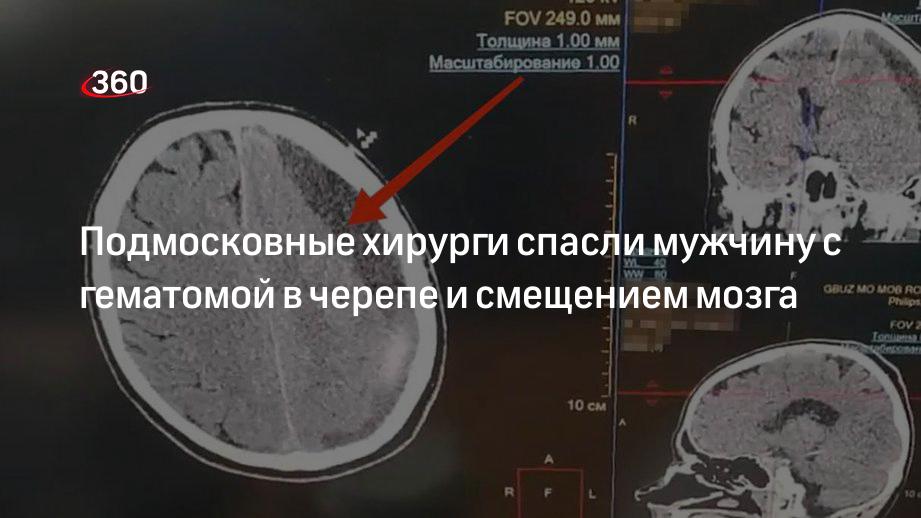 Подмосковные хирурги спасли мужчину с гематомой в черепе и смещением мозга