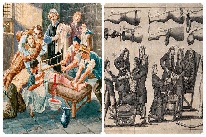 В прошлом палачи ампутировали больше частей тела, чем врачи. Наряду со смертной казнью, ампутация или нанесение увечий считались самым суровым наказанием.