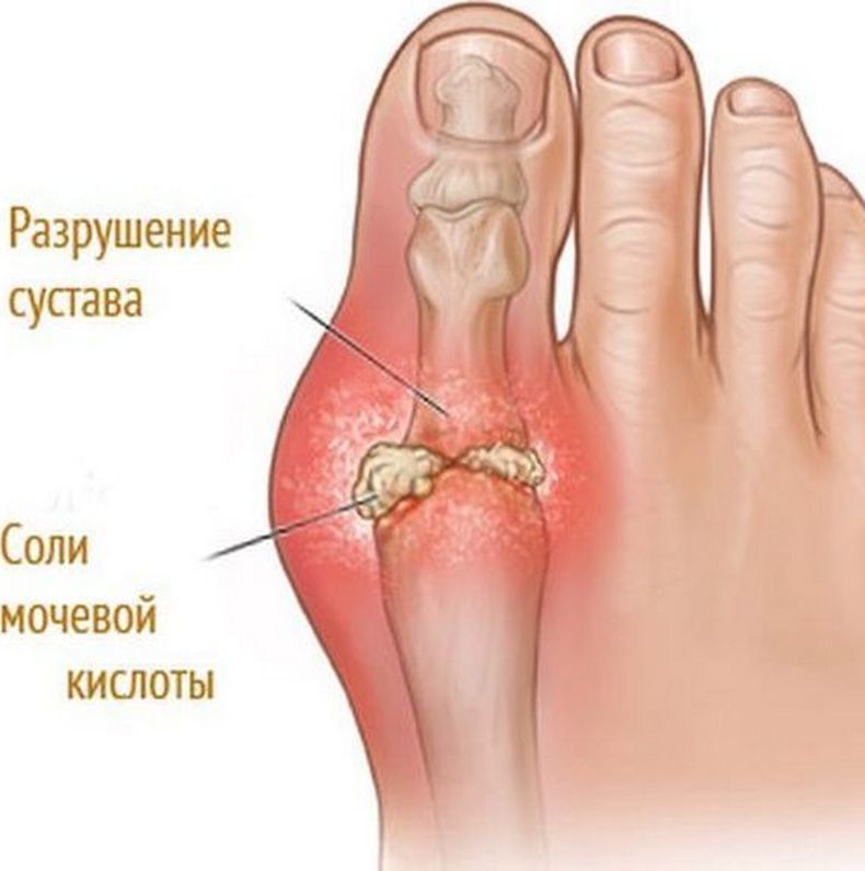 Как вывести мочевую кислоту из организма мочевой, кислоты, показателя, которые, показатель, крови, помогает, токсины, приготовления, пуринов, снизить, снижению, продукты, организме, также, суставах, случае, приводит, образом, очистить