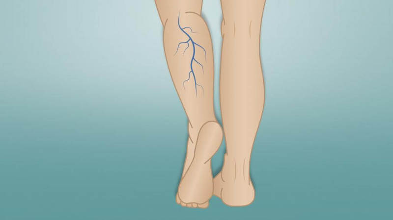 Ежедневная гимнастика при варикозном расширении вен варикоз, вены, гимнастика, здоровье