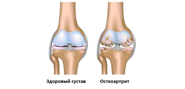 Что такое остеоартрит?