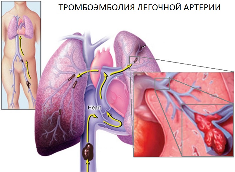 Тромбоэмболия мелких. Тромбоэмболия ветвей легочной артерии. Тромбоэмболия легочной артерии (Тэла). Эмболия тромбом легочной артерии (Тэла);.