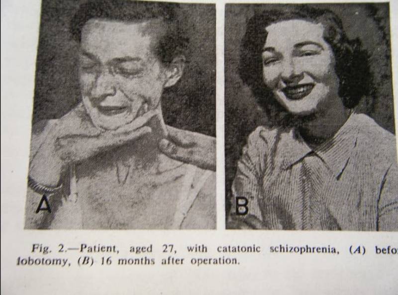 Лоботомия. История потрошения мозгов, или Самая постыдная Нобелевская премия Лоботомия. История потрошения мозгов, или Самая постыдная Нобелевская премия история